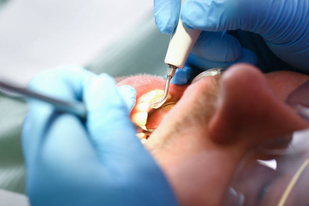Best Emergency Broken Tooth Repair in Granville, OH